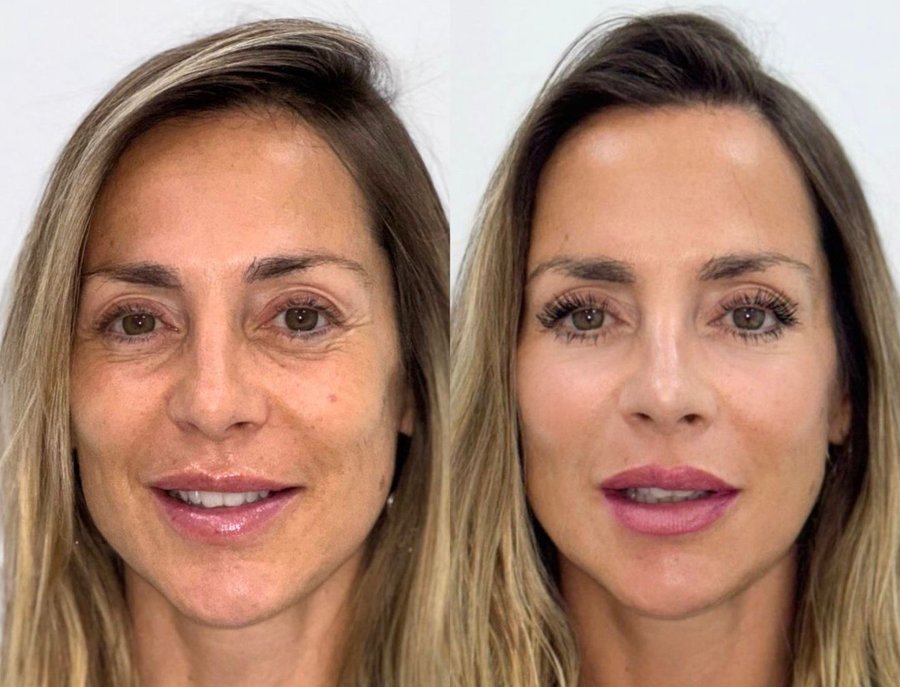 rejuvenecimiento facial antes despues